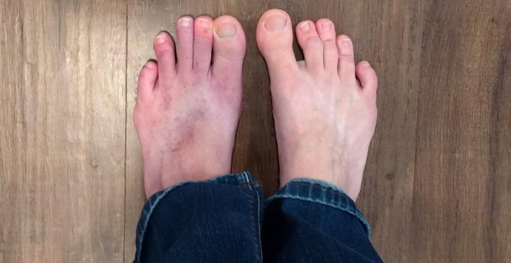 photo of my feet; left foot shows purple discoloration caused by May-Thurner Syndrome